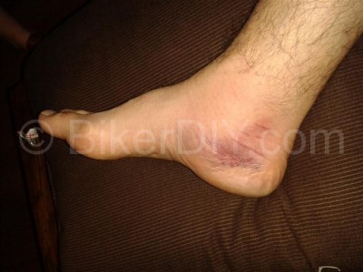 ankle with soft tissue damage after dropped bike